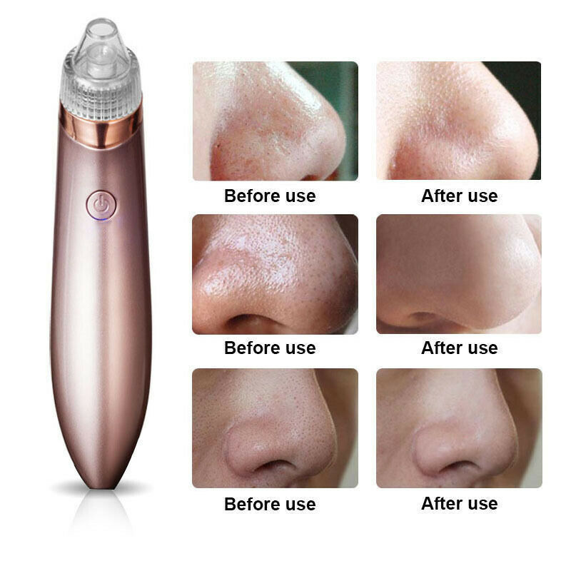 Electric Blackhead Vacuum Pore Cleaner, Acne Pimple Remover Strong Suction Tool